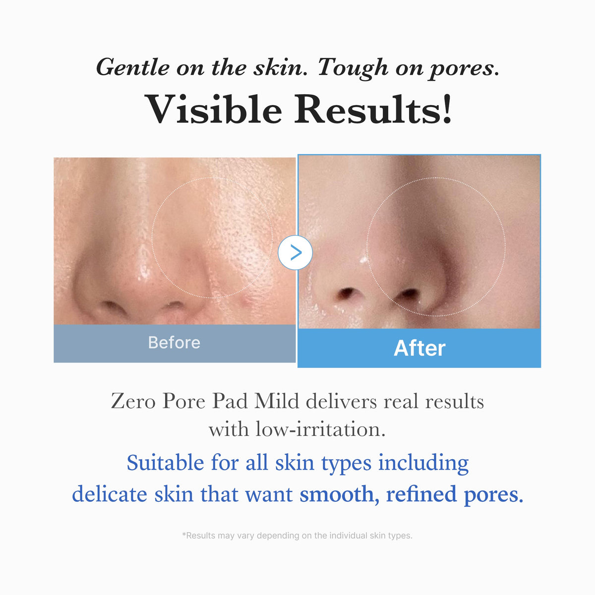 zero-pore-madecassoside-pads-mild-y5 04_6357f9f9-483b-4891-82c6-a58d336e62c8.jpg